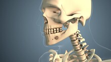 Cancer Spreading Along A Mouth Bone