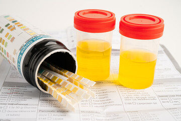 Urinalysis, urine cup with reagent strip pH paper test and comparison chart in laboratory.