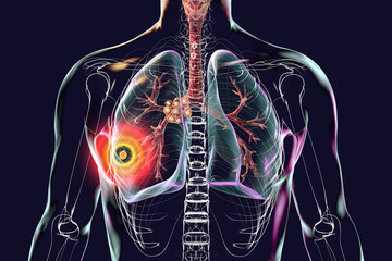 Wall Mural - Primary lung tuberculosis with the Ranke complex, 3D illustration