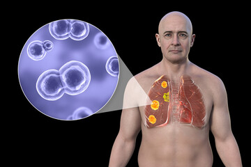 Sticker - Pulmonary blastomycosis, 3D illustration.