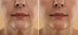 © New Africa - Aging skin changes. Woman showing face before and after rejuvenation, closeup. Collage comparing skin condition