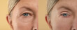 © New Africa - Aging skin changes. Woman showing face before and after rejuvenation, closeup. Collage comparing skin condition