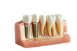 Dental implant, cut out - stock png.