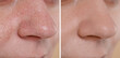 © New Africa - Blackhead treatment, before and after. Collage with photos of woman, closeup view