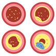 © Youjin - 동맥경화 순서와 단계. 혈관단면 아이콘. 고지혈증 이상지질혈증 혈관건강