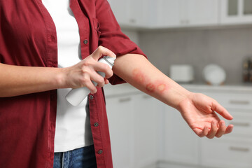 Wall Mural - Woman applying panthenol onto burns on her hand in kitchen, closeup