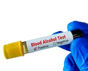 Canvas Print - Tube tube with sample for Blood alcohol test