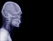 X-ray image of lateral head and cervical spine. Black background.