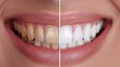 Smile transformation: Close-up of a woman's teeth before and after whitening treatment