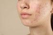 © New Africa - Teenage girl with acne problem on beige background, closeup