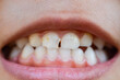 A zoomed-in image captures the mouths of children with misaligned, fractured teeth and odontolith.