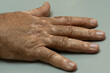 Male patient with vitiligo disease. Medical themes