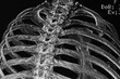 Chest CAT- SCAN of rib fracture. Medical themes