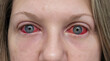 © Darren - Conjunctivitis - Pink Eyes, Covid-19 Eyes, close-up