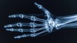 Radiograph of the hand with bone and joint abnormalities.