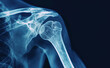 X-ray Shoulder fracture with joint proximal humerus fracture and the associated injury