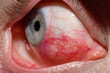 Duże zbliżenie na otwarte oko ze stanem zapalnym, czerwone żyłki w oku