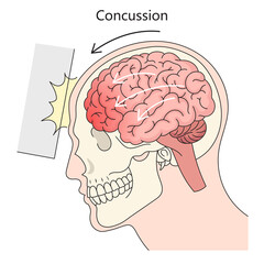 Human brain concussion structure diagram hand drawn schematic raster illustration. Medical science educational illustration