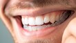 Young Caucasian man inserting a dental aligner. Close-up view. The transformative journey of a smile, aligner style.