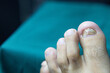 © Tsagay - Close-up of big toenail ruptured and infected with fungus