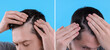Man showing hair before and after dandruff treatment on light blue background, collage