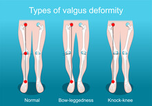 Valgus Deformities. Knee Deformity. Corrective Surgery
