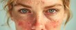 Person with red rash on face likely due to an allergic reaction. Concept Allergic Reaction, Red Rash on Face, Skin Irritation, Facial Allergy, Dermatitis
