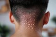 © LifeMedia - Focus on inflamed hair follicles on the back of head indicating symptoms of folliculitis in an adult male
