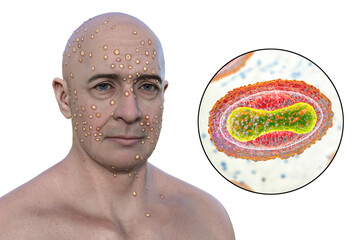 Wall Mural - 3D illustration depicts man with rash from pox viruses (smallpox, Alaskapox, monkeypox), alongside with close-up view of Poxviridae viruses.