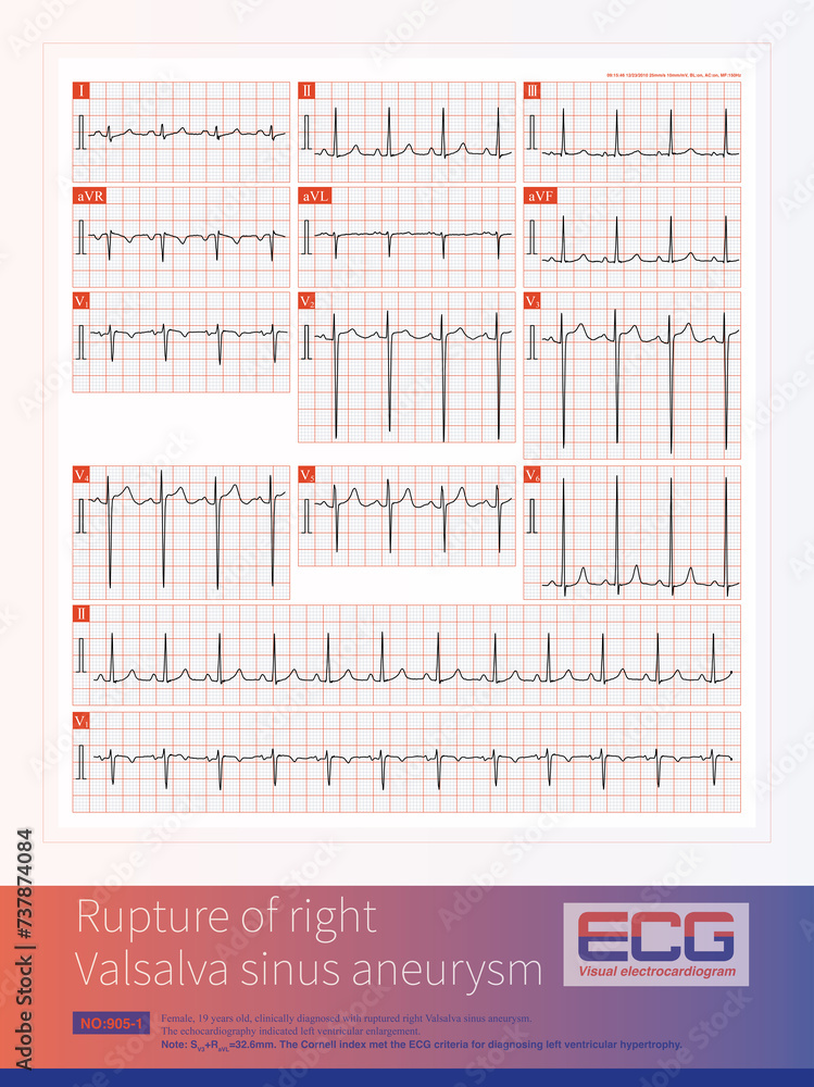 Female, 19 years old, clinically diagnosed with rupture of right ...
