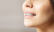 © timofeev - Closeup Metal Brackets on Teeth. Orthodontic Dental. Woman Healthy Smile. Female Smile with Braces. Close up of white teeth with braces. Dental care and treatment. Girl smile with Braces accessories