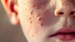 Vue du visage d'un jeune garçon abimé par les boutons » IA générative