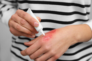 Canvas Print - Woman applying healing cream onto burned hand, closeup