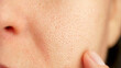 © julia_diak - skin texture with enlarged pores. Problem skin. part of a woman face. acne. skin, pore, face, dry, acne