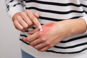 Poster - Woman applying healing cream onto burned hand on light grey background, closeup