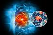 © Crystal light - Spine cancer or spinal tumor disease.3d illustration