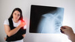 The doctor holds in his hand a medical x-ray of a dislocated humerus and a fractured collarbone against the background of a girl patient whose shoulder hurts. Fixing bandage for the shoulder joint. 