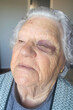 © Chris DoAl - elderly woman with a bruise on her eye after suffering a blow