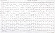 © sebi_2569 - ECG electrocardiogram of a heart disease person