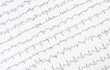 ECG electrocardiogram of a heart disease person