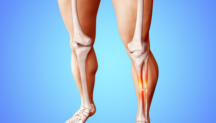 Wall Mural - Medical Illustration of Broken Tibia and Fibula on Athletic Male Body