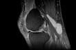 Nuclear Magnetic Resonance of right knee that shows baker cyst, fracture of external meniscus and hydrarthrosis. Medical themes
