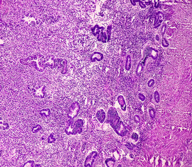 Canvas Print - Uterus with adnexa (biopsy): Cervix show chronic inflamatory cells, wall show secretory phase in endometrium and fallopian tube show paratubal cyst. fimbrial cyst, Paraovarian cyst.