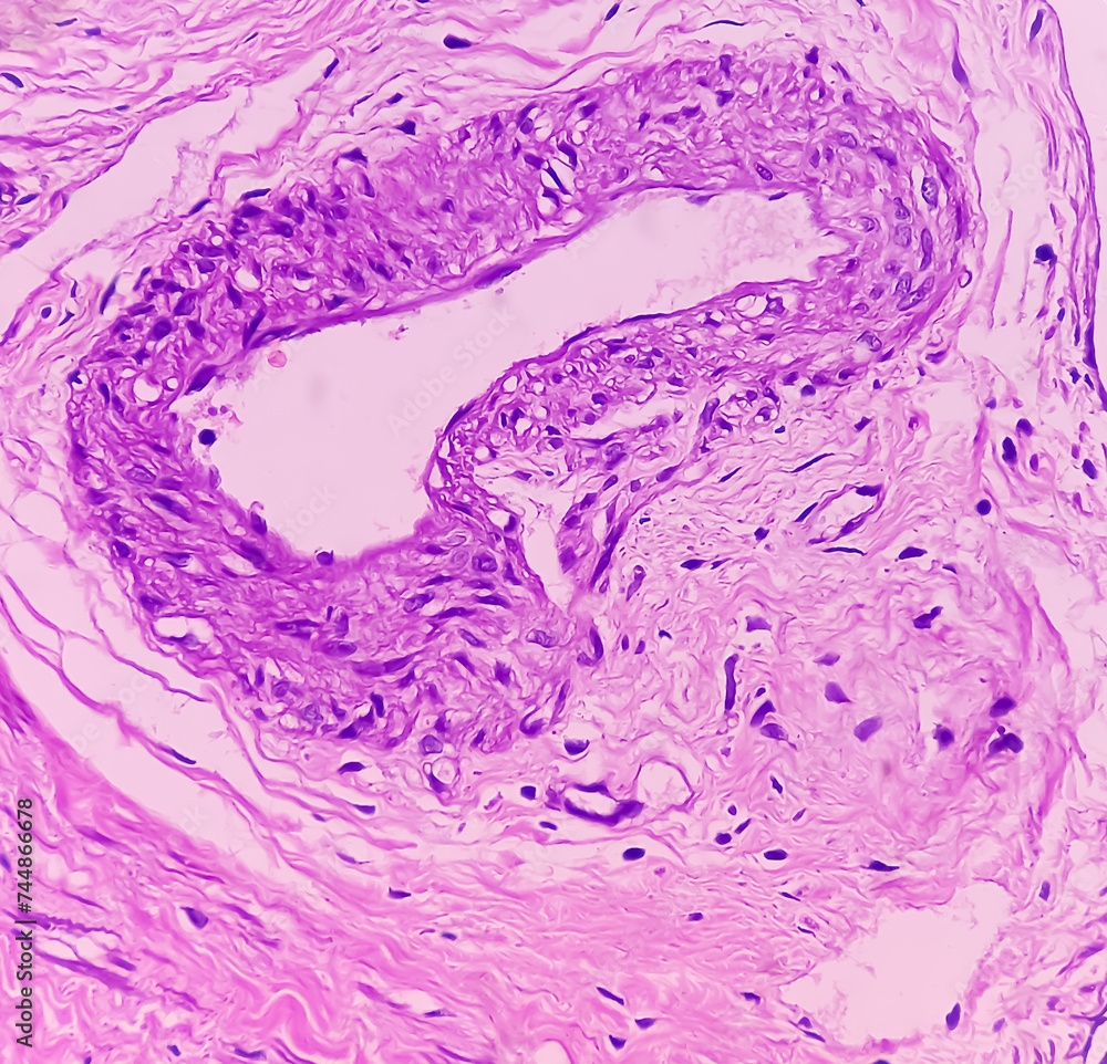 Uterus with adnexa (biopsy): Cervix show chronic inflamatory cells ...