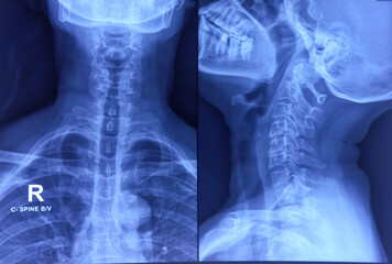 Wall Mural - Cervical spine x-ray showing spondylosis of cervical spine. Marginal osteophytes. Cervical spondylosis.