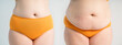© staras - Woman's belly before and after liposuction and weight loss on gray background, plastic surgery concept