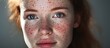 Young Woman with Rosacea Sensitive Skin Showing Red Spots on Cheeks, Close-up Patient Face