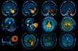 Illustration of MRI sequence showing the progression of a brain tumor over time from initial diagnosis to advanced stage. Each frame illustrates a different stage.