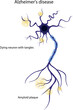 Damaged neuron. The structure of a diseased neuron. Alzheimers disease. Brain disease dementia, memory disorders.