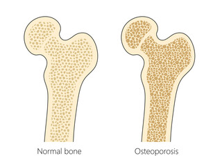 human bone structure with osteoporosis diagram hand drawn schematic vector illustration. Medical science educational illustration